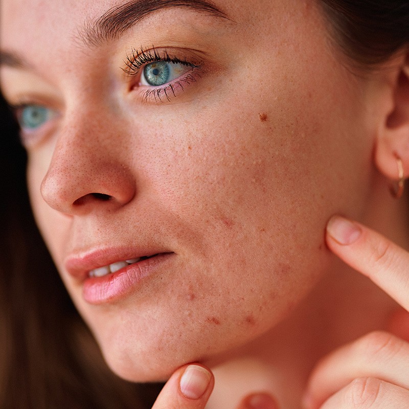 Come eliminare i brufoli sottopelle: cause, rimedi e consigli di bellezza